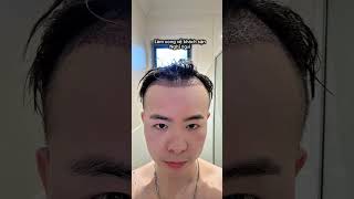 Chi hơn 10k để cấy tóc tại Sydney và cái kết đáng báo động ! Brian ttwo #cuộcsốngúc 
