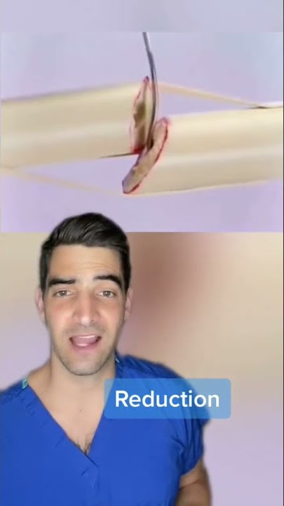 Fixing a Broken Bone