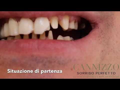 Video: Impianto Dentale Basale Di Alta Qualità