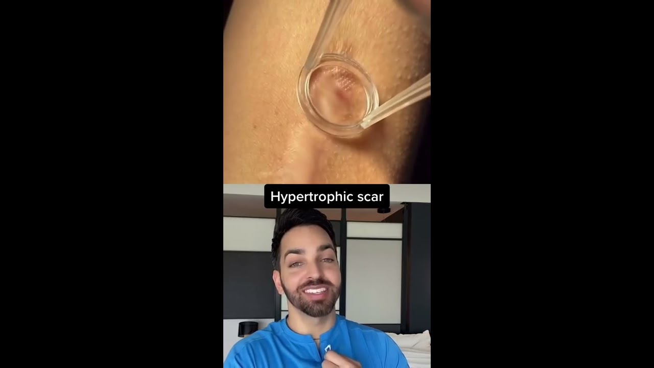 Dr Shah Reacts To Scar Treatment Shorts