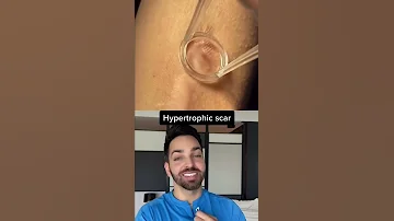 Dr Shah Reacts To Scar Treatment Shorts 