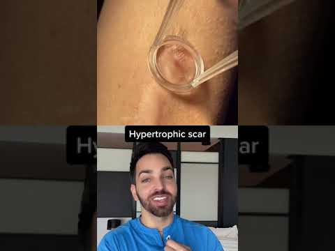 Video: Helpt betamethasonvaleraat acne?