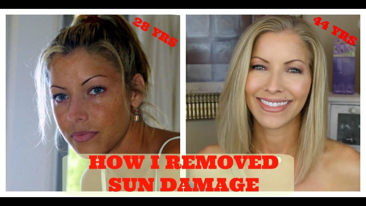 Fade Dark Spots Hyperpigmentation & Melasma with these ... Fade Dark Spots Hyperpigmentation & Melasma with these ...