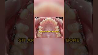 Can Braces Change Your Face Shape?