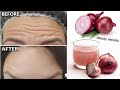 1 onion is a million times stronger than botox it eliminates wrinkles and fine lines instantly