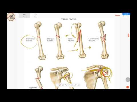 Video: SCAN: Menyampaikan Diagnosis Gangguan Tulang, Penyembuhan Patah