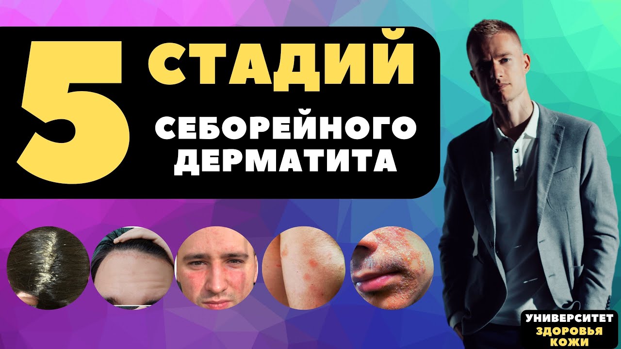5 стадий себорейного дерматита и подходящее лечение. Павел Ястремский ...