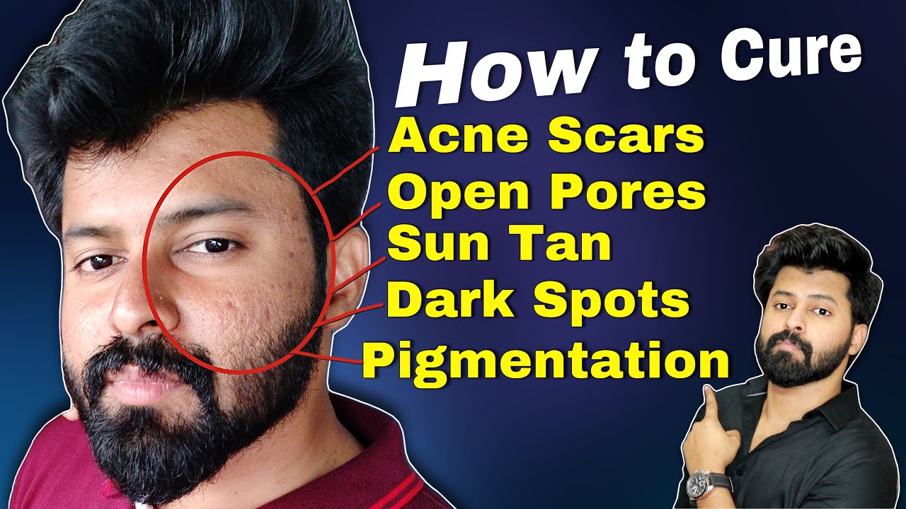 Acne Scars , Dark spots , Pigmentation, Hair removal , Sun tan