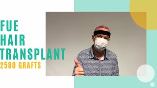 FUE hair transplant, 2580 grafts with Dr. Ilker Apaydin in Turkey