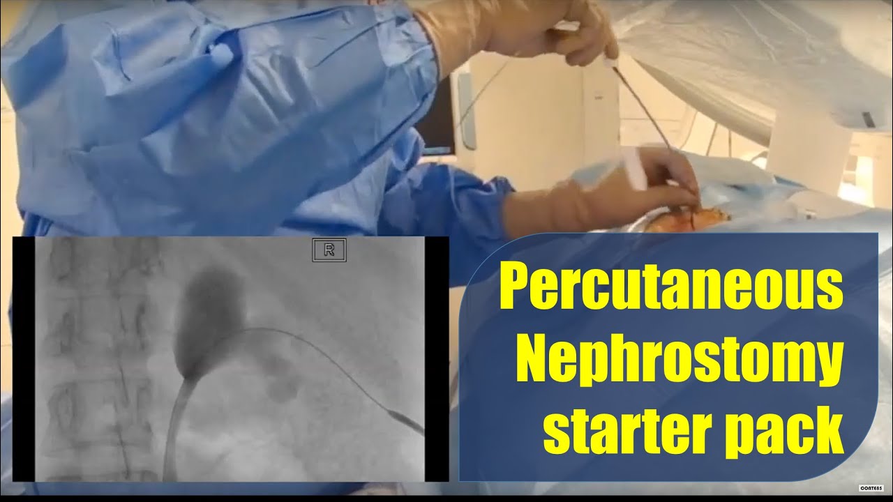 Percutaneous Nephrostomy procedure and technique starter