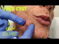 Face Cyst Treatment. Dr Khaled Sadek. LipomaCyst.com