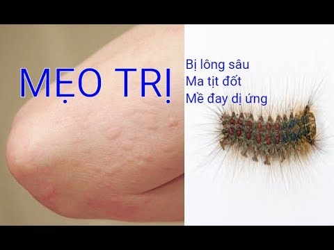 Video Mẹo chữa lông sâu, ma tịt đốt, ngứa dị ứng không cần... - youtube