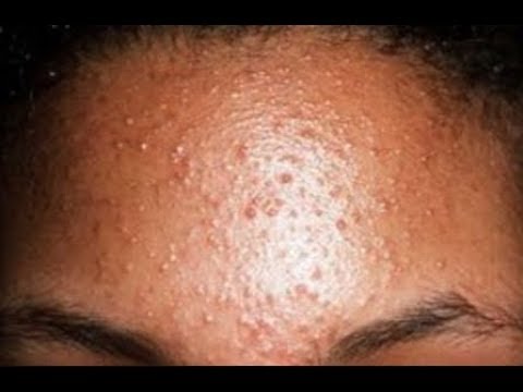 How to Get Rid of Bumps on Forehead