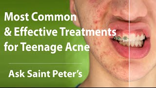 Most Common & Effective Treatments for Teenage Acne  | Ask Saint Peter's