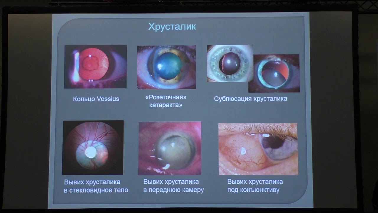 сублюксация хрусталика