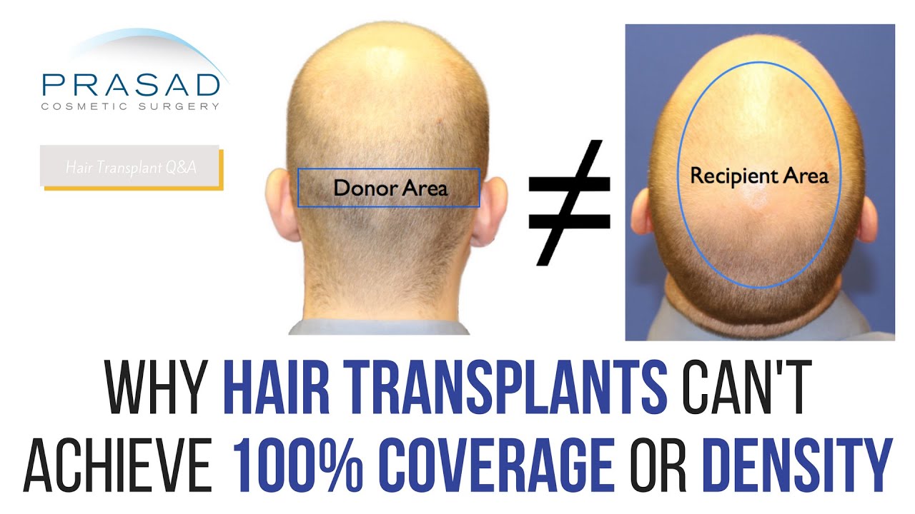 Follicular Unit Extraction FUE Explained