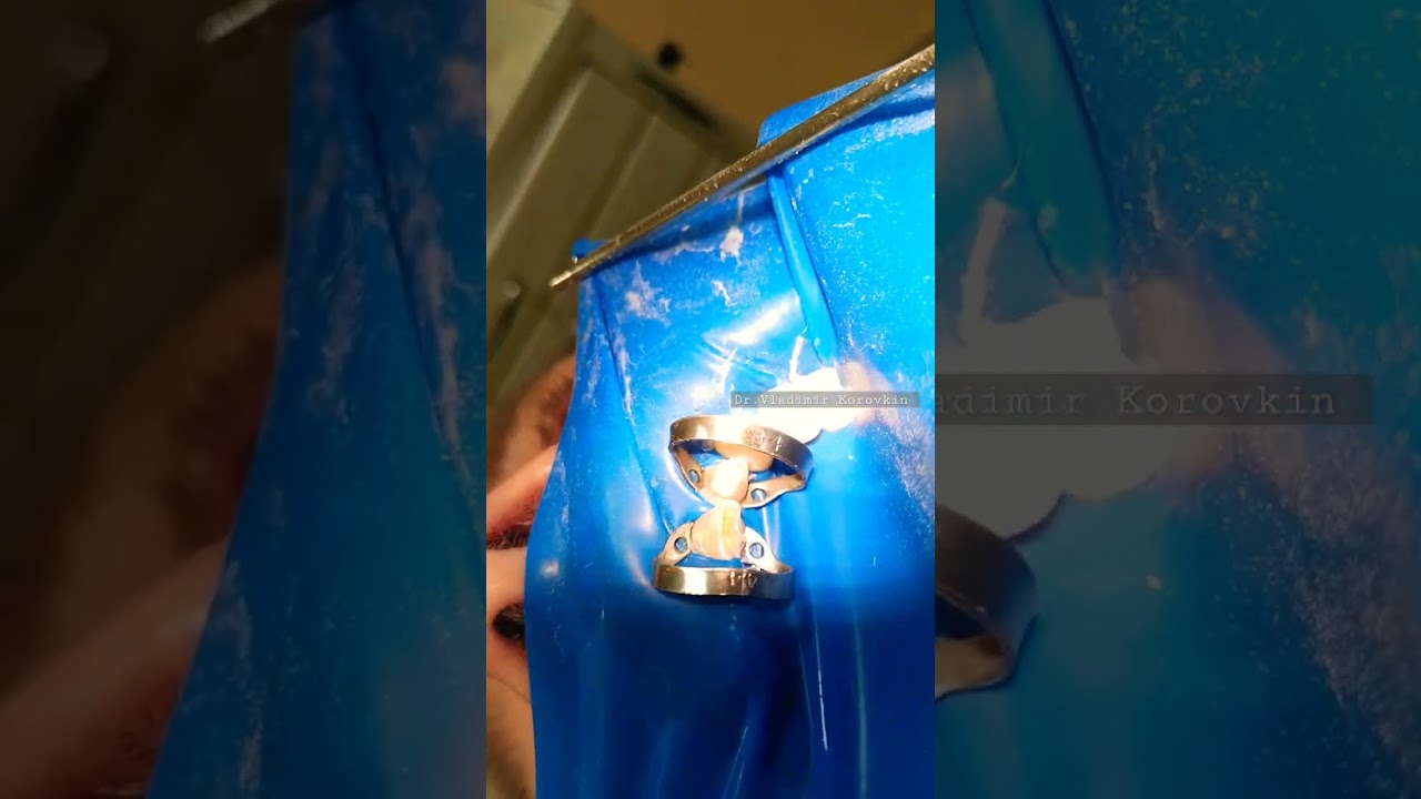 Установка клампов Sowdan B4;44.21-22. Sanctuary medium blue case #16.