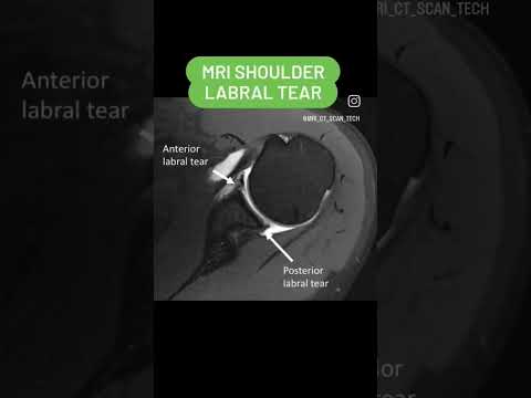 Labral Tear MRI