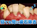 😪寝てる間に歯石除去💤睡眠中去除牙石🦷Calculus removal while sleeping