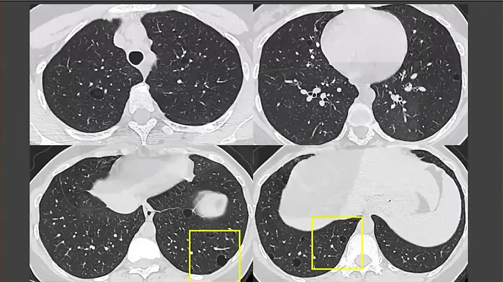 Holy Holes! Cystic Lung Disease on HRCT