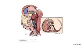 Abdominal Exposure