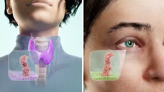 The Autoimmune Link Behind Graves Disease And Ted