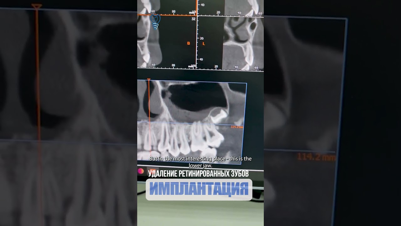 Удаление ретинированных зубов. Removal of retinated teeth.