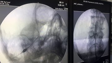 Gasserian ganglion block