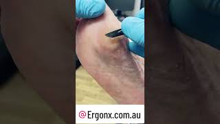 Thick forefoot callus removal by podiatrist can help to prevent infection