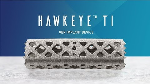 ChoiceSpine: Hawkeye TI Cervical Corpectomy