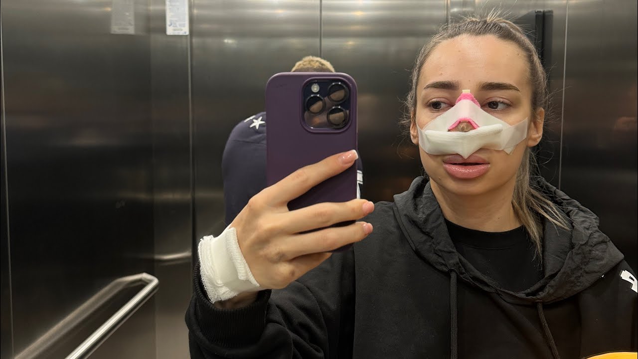 Mi-am facut Rinoplastie