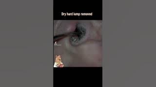 Hard dry wax lump removed from ear #ear #earwax #earwaxremoval #earcarespecialists #cerumen