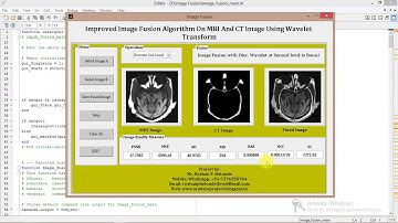 Image Fusion On MRI and CT Image Using Matlab Project Code