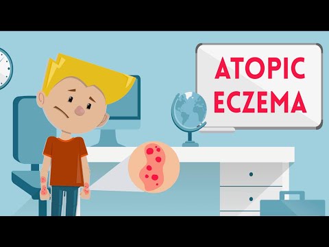 Atopic Eczema