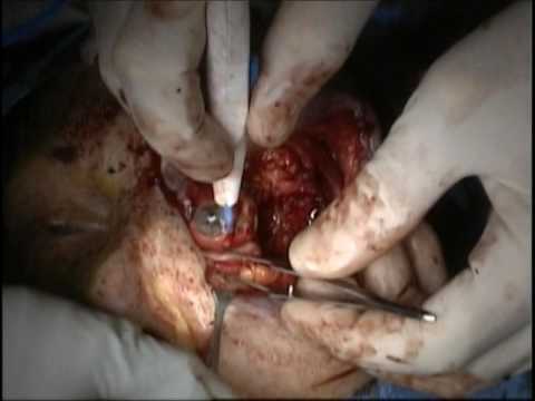 Video: Lacrimal Gland - Behandling, Blokkering, Betennelse