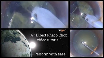 The Direct Phaco Chop under topical anaesthesia - how to fine tune the technique to get best results