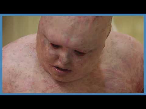 Rare Skin Conditions Makes His Skin Tear From Touch | Body Bizarre