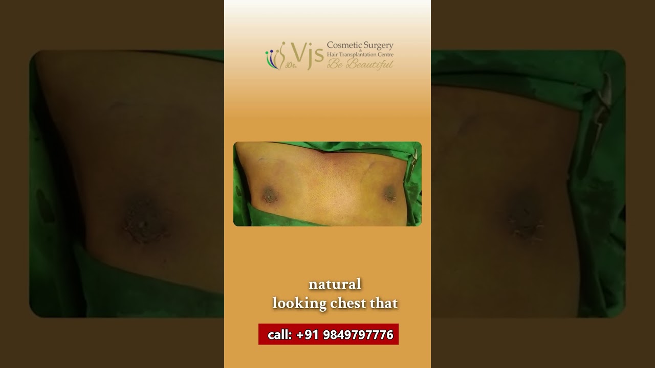 Real Gynecomastia Results | Vizag Chest Transformation | VJ’s Clinics