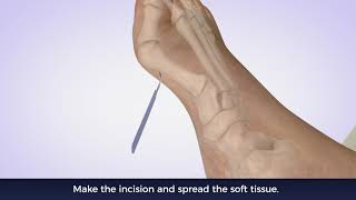 Bunionplasty Precision Foot Surgery Animation By Pulse 3D Media