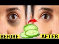 Remove Dark Circles Permanently in 3 days  (100% Works) - How To Remove Dark Circles