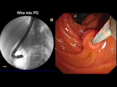 ERCP: IDIOPATHIC FIBROSING PANCREATITIS