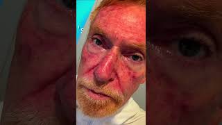Efudex Treatment - Week 2 Update (Fluorouracil 5% Skin Cancer Journey)