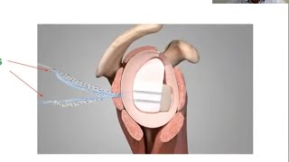 Bone Block ICBG Metal Free Cerclage for Glenoid Bone Loss