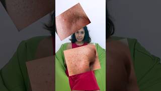 Whiteheads, Blackheads മാറാൻ ഏതു സെറം ഉപയോഗിക്കണം? #lekshmikrishnan