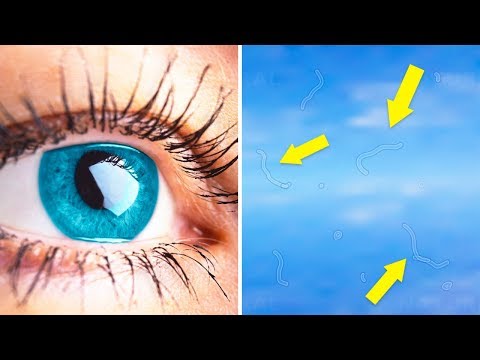 If You’re Seeing Eye Floaters, Here’s What to Do About Them
