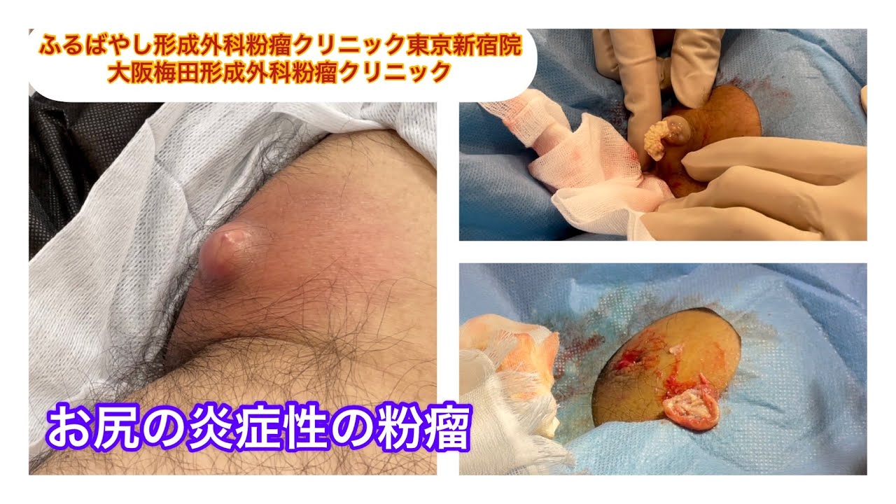 炎症した粉瘤 ふるばやし形成外科粉瘤クリニック東京新宿院