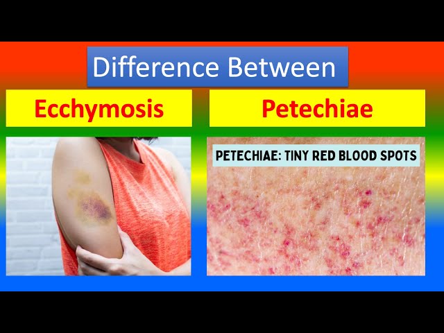 Blood Rashes What Does Petechiae Blood Spots Look Like