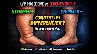Signe de Stemmer : Le test infaillible pour le lymphœdème 