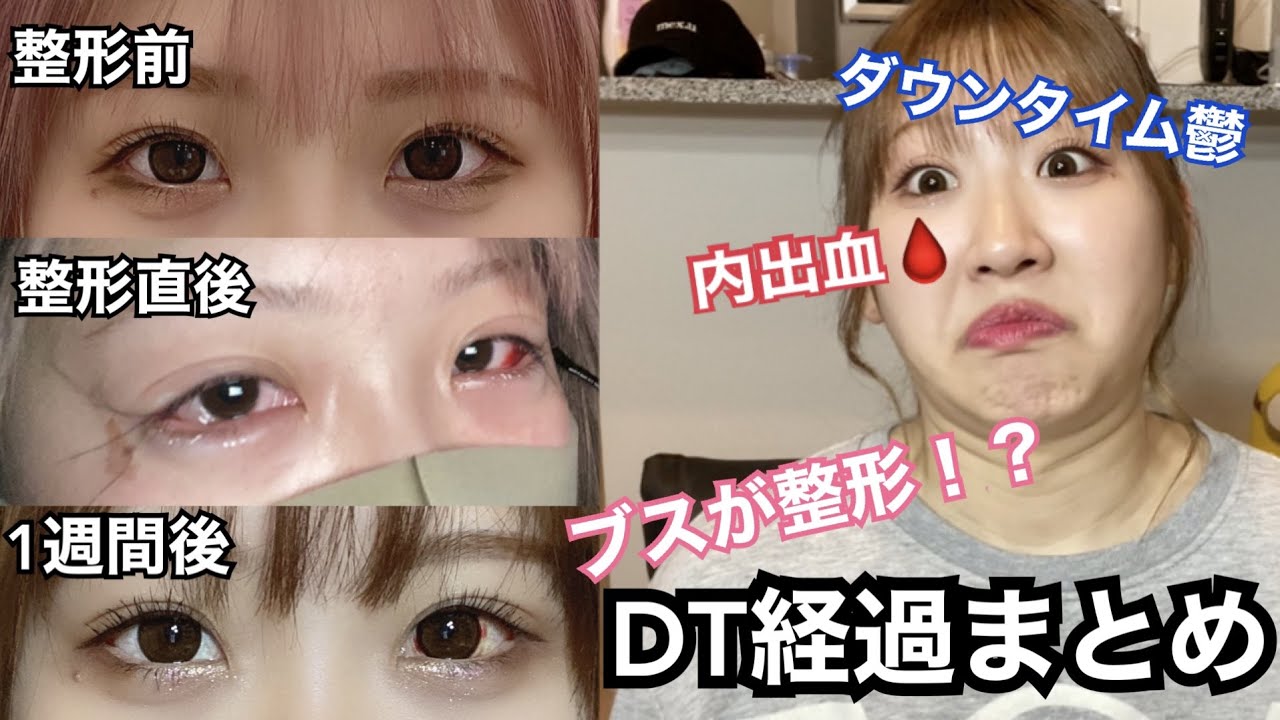 整形 目尻切開 たれ目形成 ダウンタイム経過まとめ 手術前 完成まで Youtube