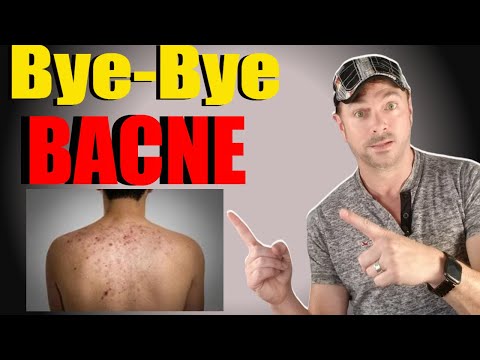 CLEAR BACK ACNE WITH THIS ACNE TREATMENT VIDEO